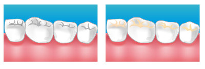 Soin des Caries dentaire au Centre Dentaire Saint-Denis Basilique (93200)