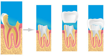 Prothèse dentaire au Centre Dentaire Saint-Denis Basilique (93200) : la couronne